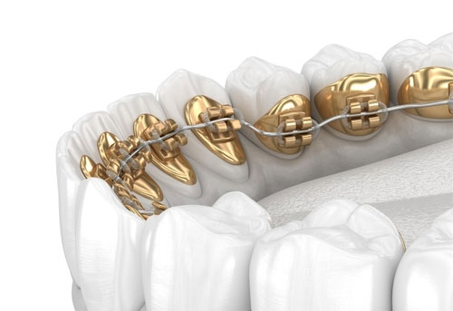 The image shows a set of gold dental braces with an accompanying wire, displayed against a white background.
