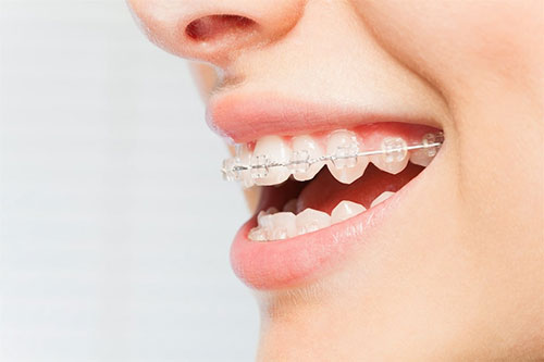 The image shows a person with an open mouth, revealing a set of braces and teeth.