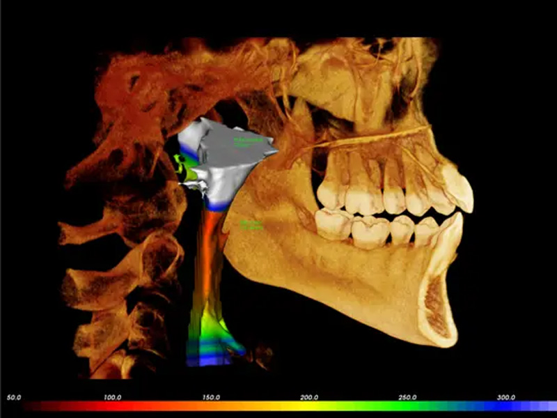 The image shows a three-dimensional medical scan of a human head with various color-coded areas highlighting different aspects or issues, likely for diagnostic purposes.