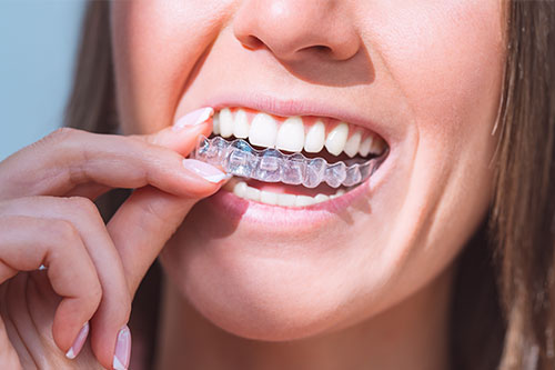 A person holding a transparent dental aligner, showcasing a bright smile.