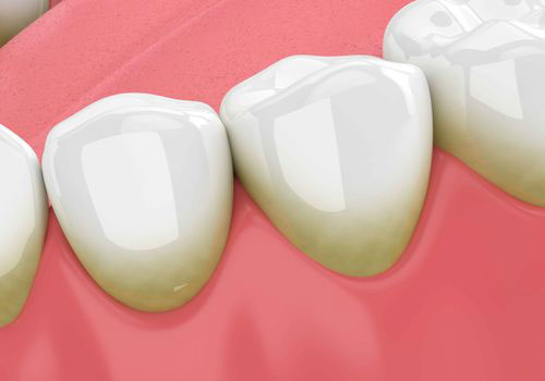 The image shows a close-up of a set of human teeth with artificial yellow stains, possibly representing the effects of tooth decay or poor oral hygiene.