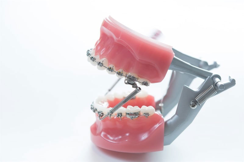 An image of a dental implant fixture with multiple teeth attachments, showcasing the appliance s design for dental restorations.