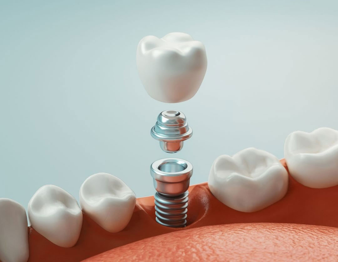 The image displays a close-up of a tooth with a screw inserted into it, placed against a background that includes a partial view of an upper denture and what appears to be a human mouth.