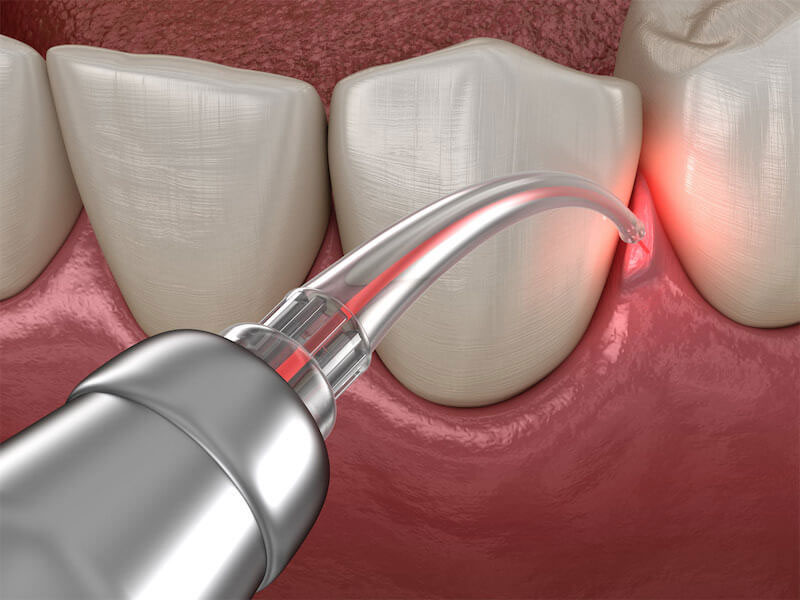 An image of a dental procedure with a red laser pointer and a syringe-like device being used on a tooth in a mouth model.