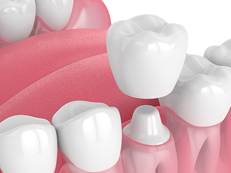 An image depicting a close-up of multiple tooth implants arranged in a smile-like pattern, with a pink gum line and a background that suggests a dental office setting.